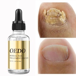 Fungal nail treatment - essential oilTreatment