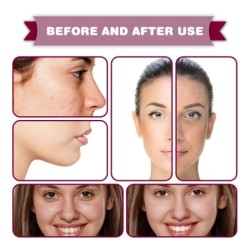 PielSuero facial - esencia de ácido de frutas - AHA - BHA - tratamiento del acné - blanqueamiento - 30ml
